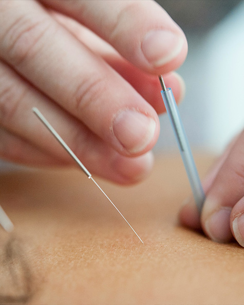 L’Agopuntura: la pratica.